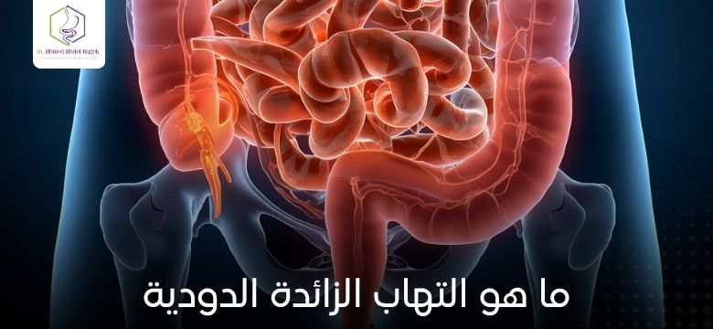 ما هو التهاب الزائدة الدودية