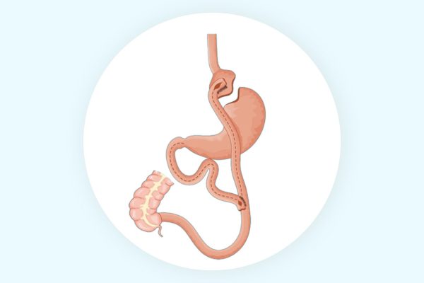 جراحات السمنة وتصحيح جراحات السمنة بالمنظار