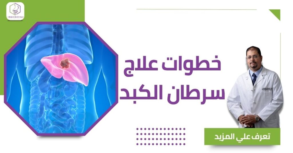 خطوات علاج سرطان الكبد