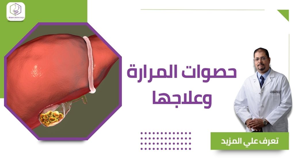 حصوات المرارة وعلاجها