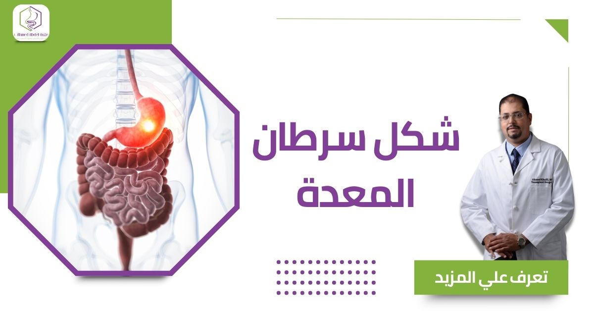 شكل سرطان المعدة