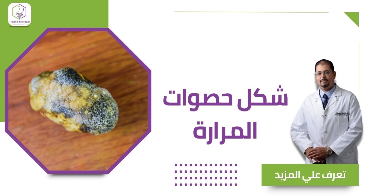 شكل حصوات المرارة