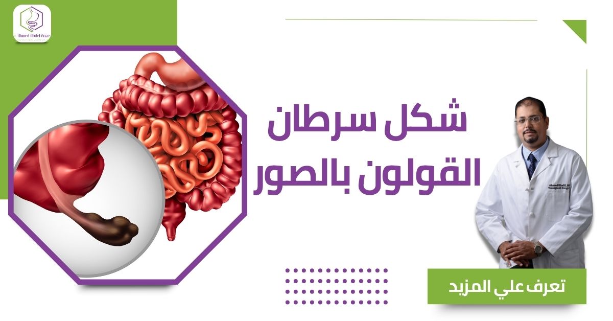 شكل سرطان القولون بالصور