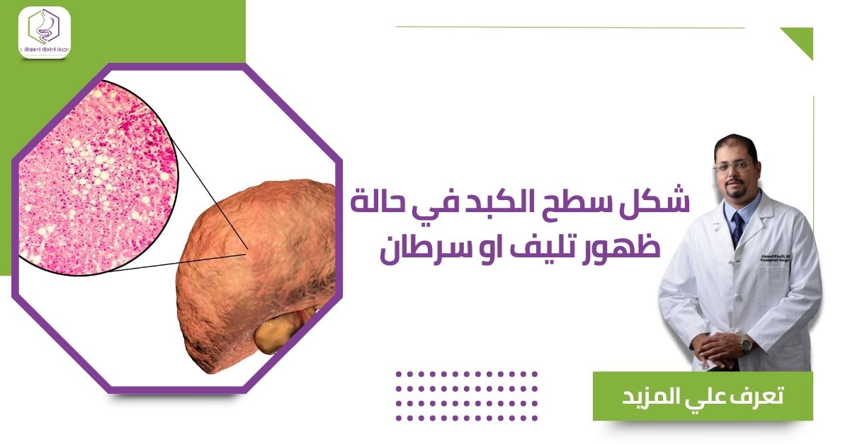 شكل سطح الكبد في حالة ظهور تليف او سرطان