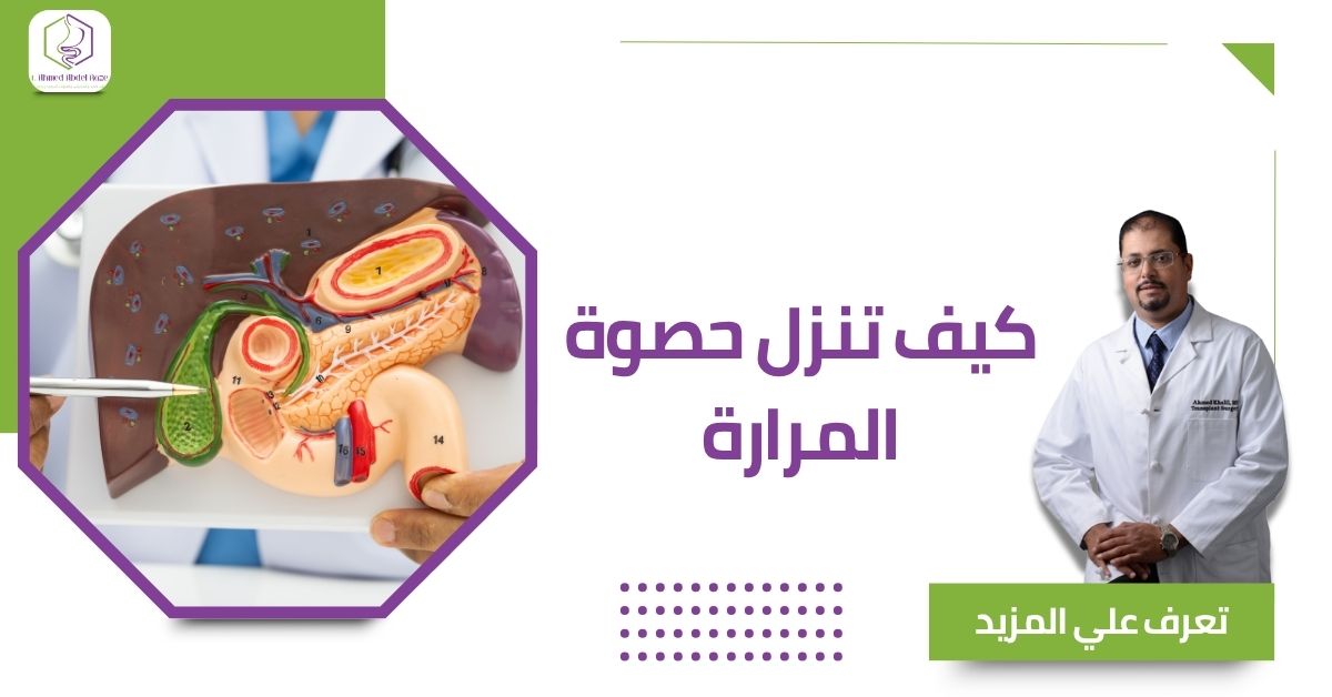 كيف تنزل حصوة المرارة