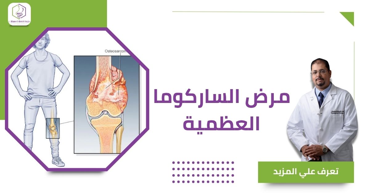 مرض الساركوما العظمية