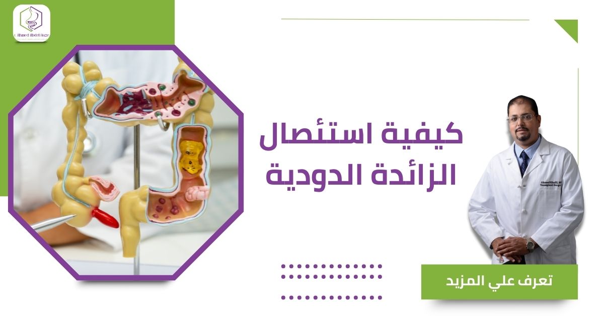 كيفية استئصال الزائدة الدودية