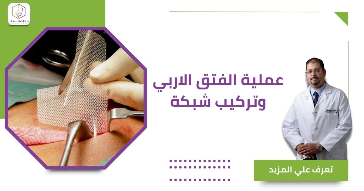 عملية الفتق الاربي وتركيب شبكة