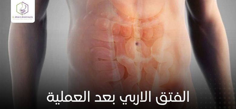 الفتق الاربي بعد العملية