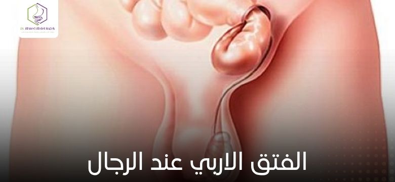 الفتق الاربي عند الرجال