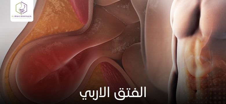 الفتق الاربي