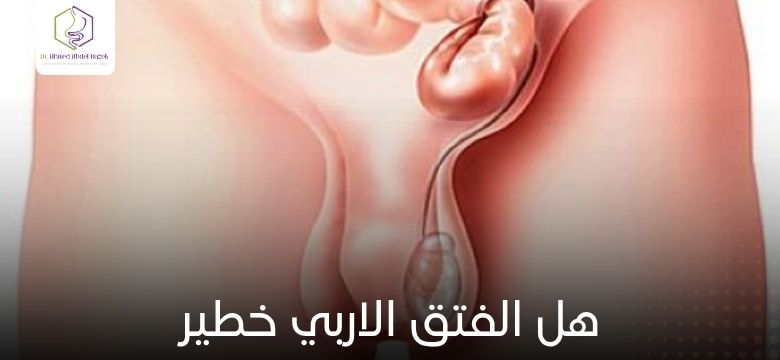 هل الفتق الاربي خطير