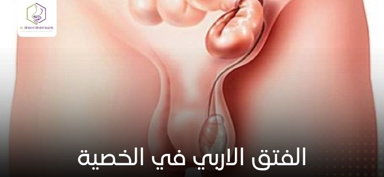 الفتق الاربي في الخصية