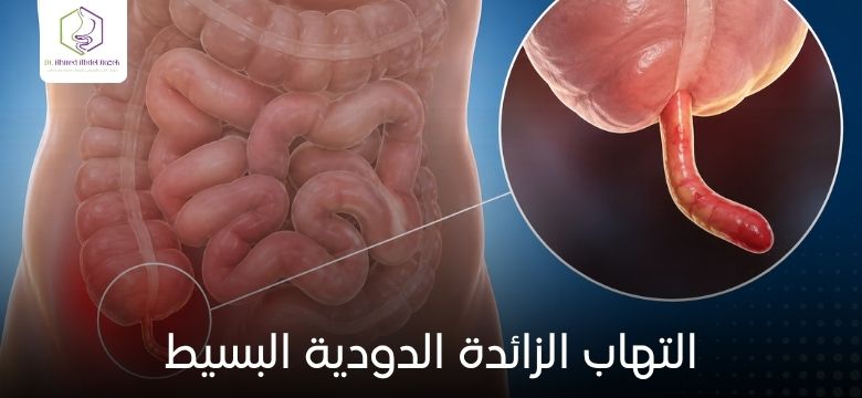 التهاب الزائدة الدودية البسيط