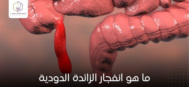 ما هو انفجار الزائدة الدودية