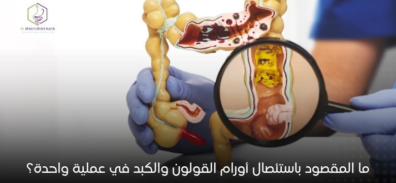 ما المقصود باستئصال أورام القولون والكبد في عملية واحدة؟