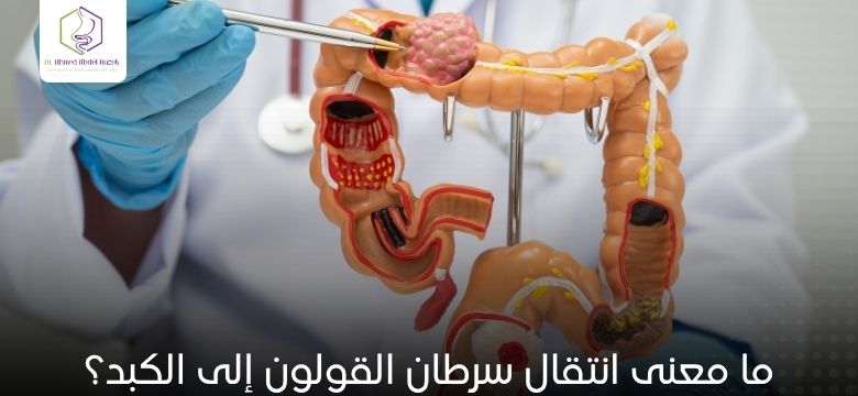 ما معنى انتقال سرطان القولون إلى الكبد؟
