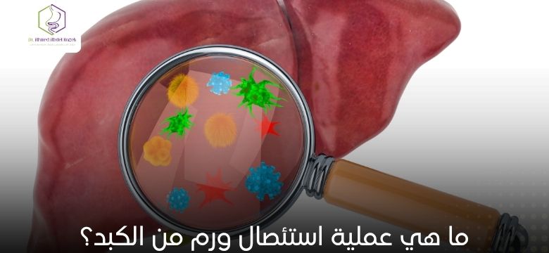 ما هي عملية استئصال ورم من الكبد؟