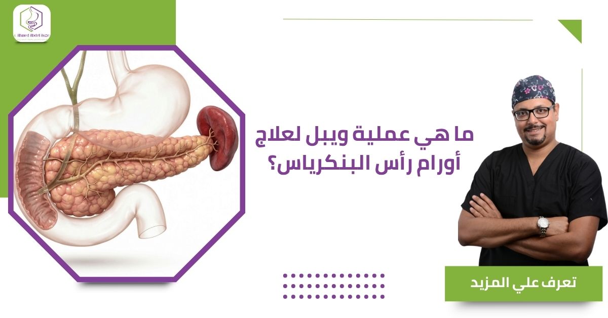 ما هي عملية ويبل لعلاج أورام رأس البنكرياس؟