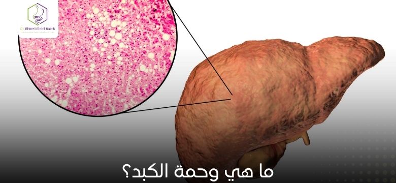ما هي وحمة الكبد؟