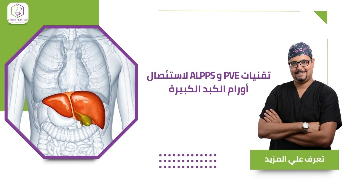 تقنيات PVE و ALPPS لاستئصال أورام الكبد الكبيرة